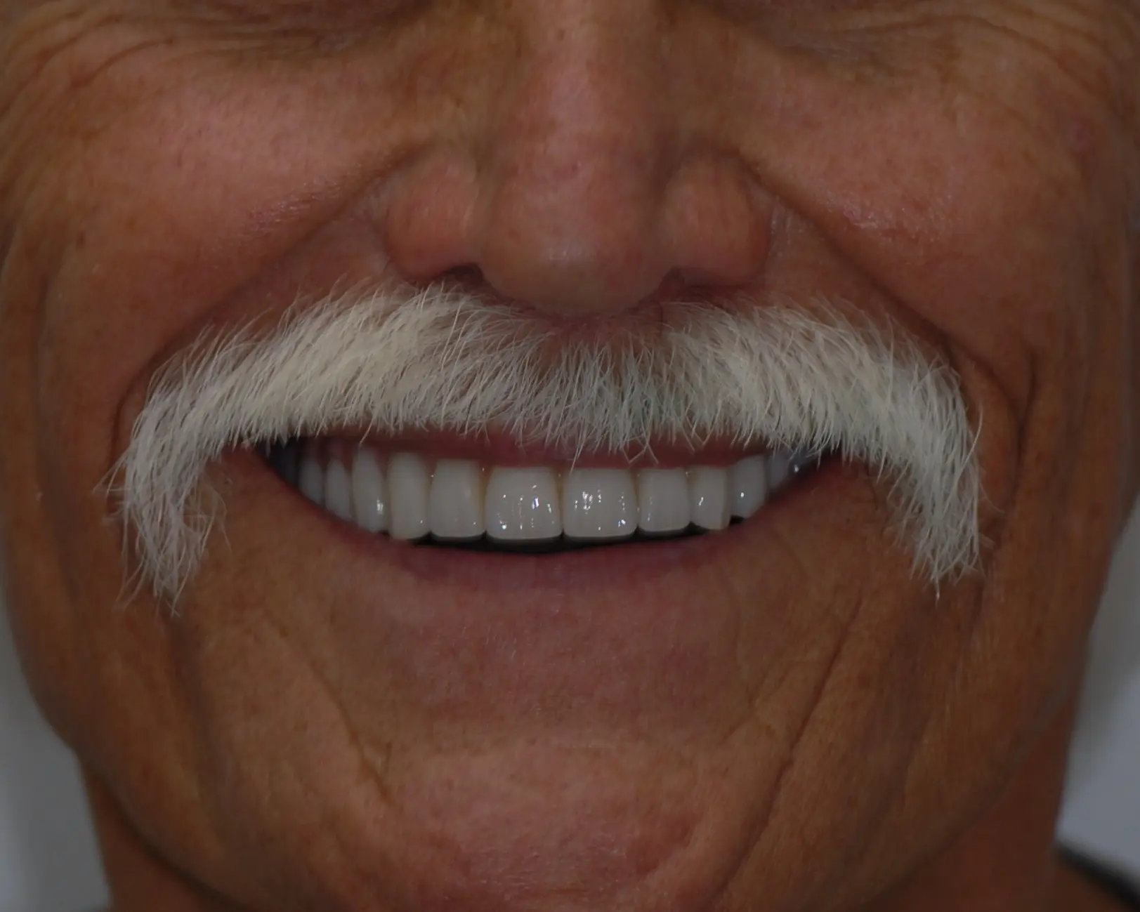 After All-on-4 Implant-Supported Dentures