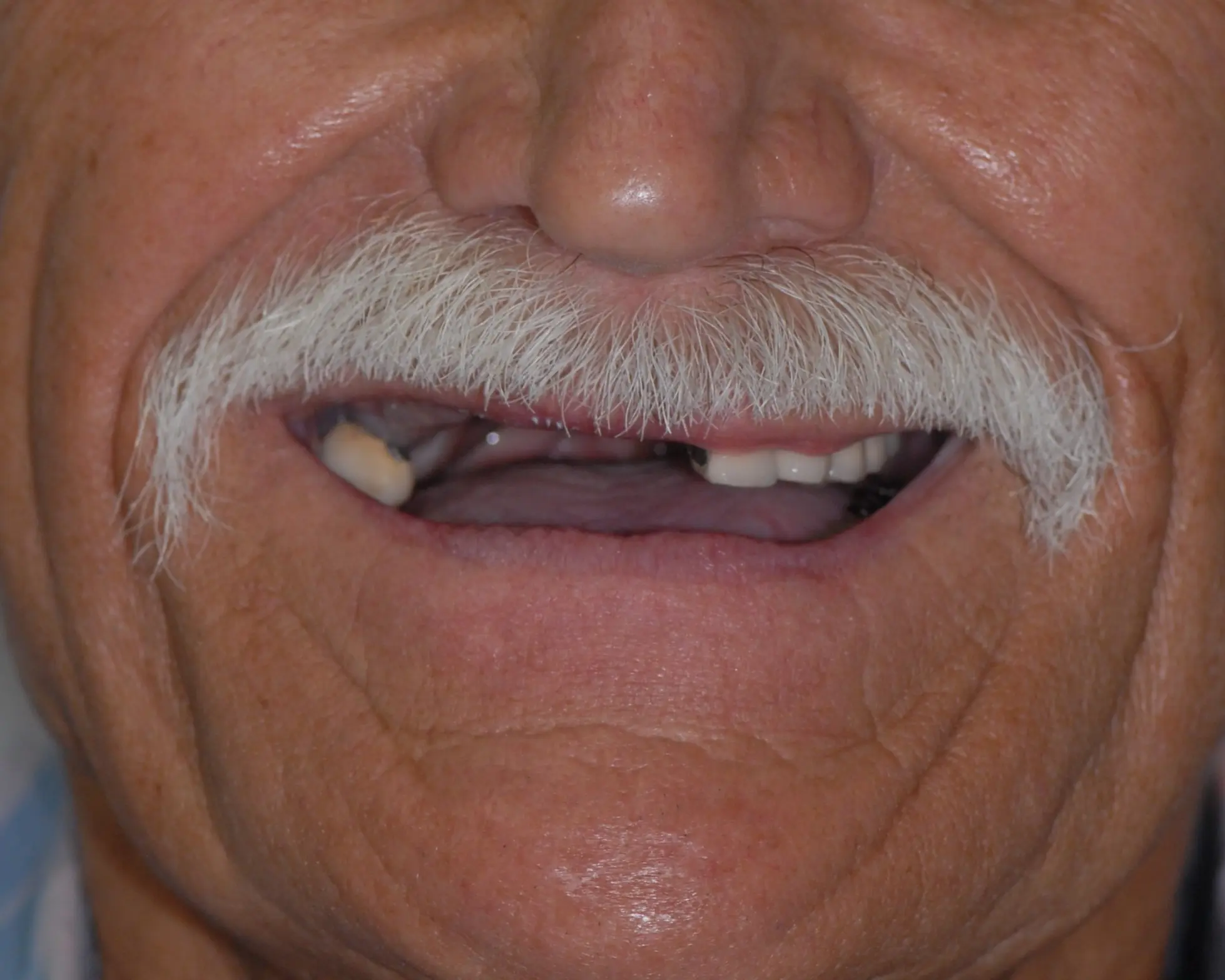 Before All-on-4 Implant-Supported Dentures