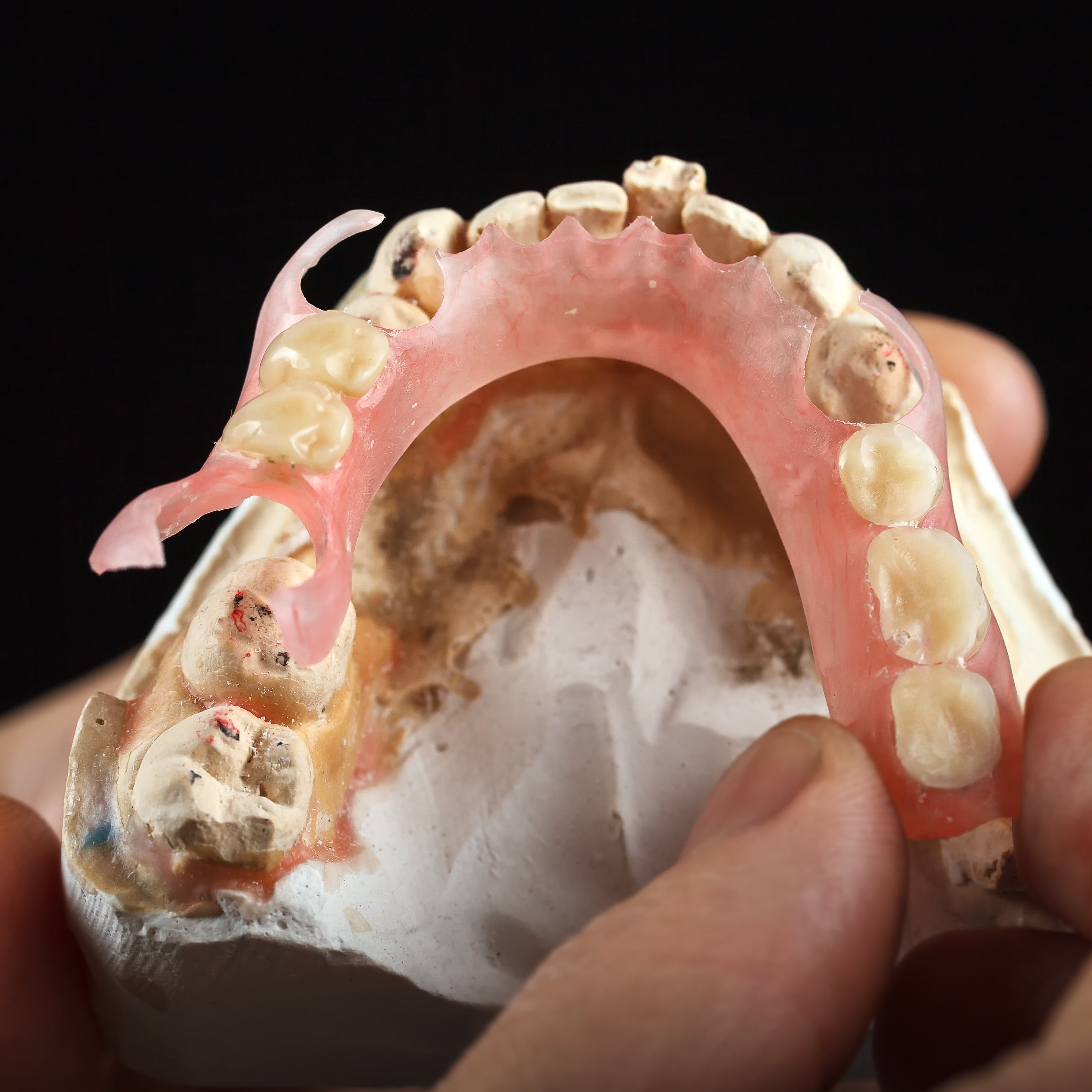 removable partial denture